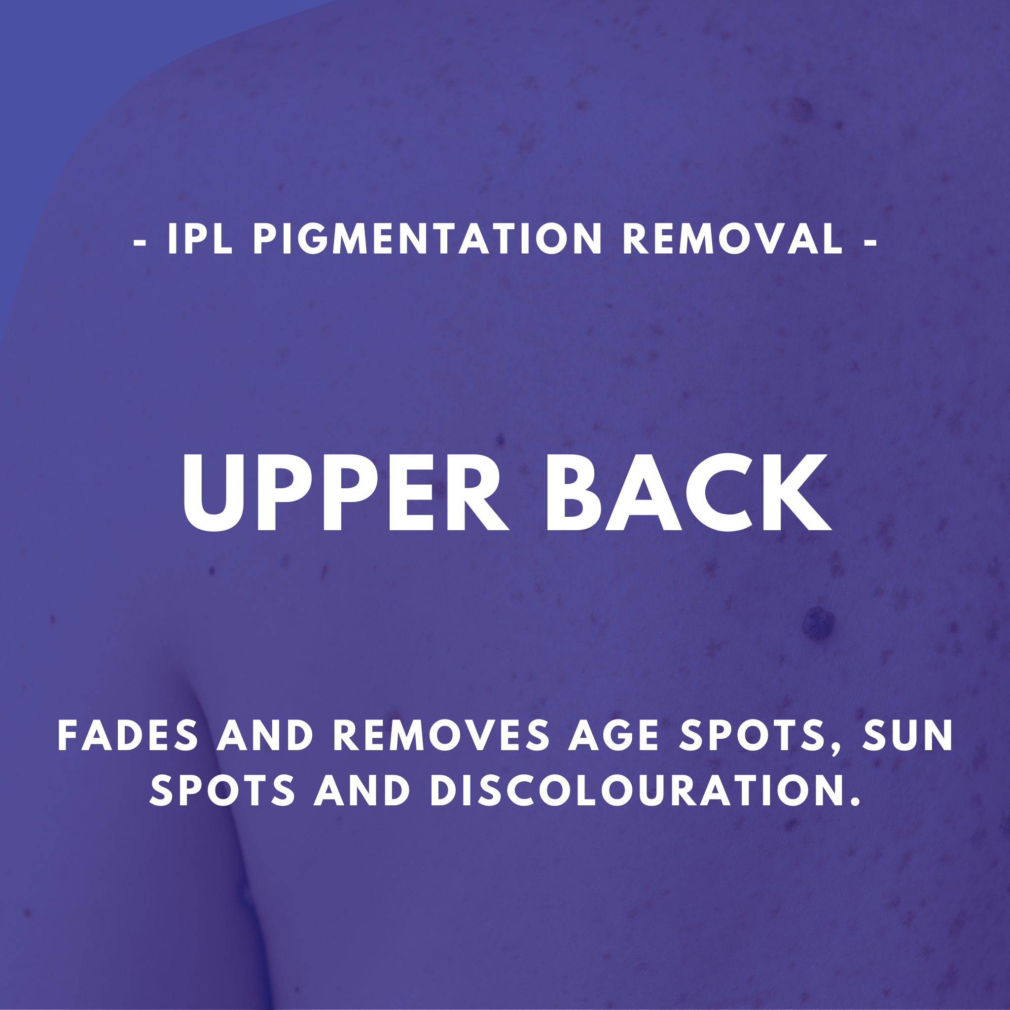 IPL Pigmentation Removal