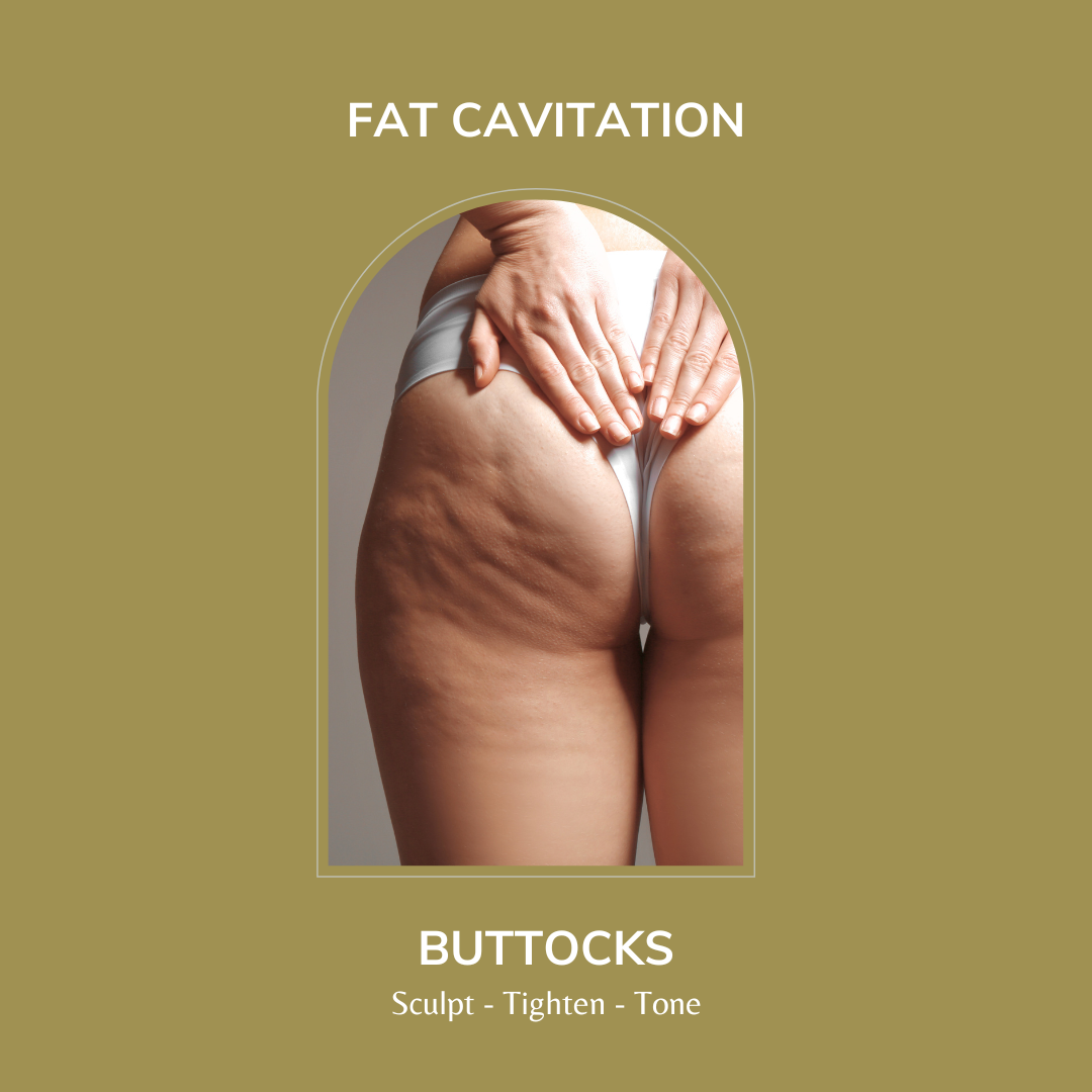 Buttocks - Fat Cavitation
