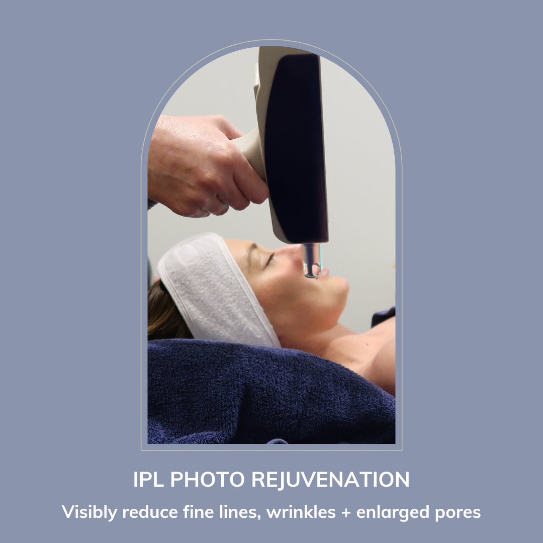 IPL Photo Rejuvenation