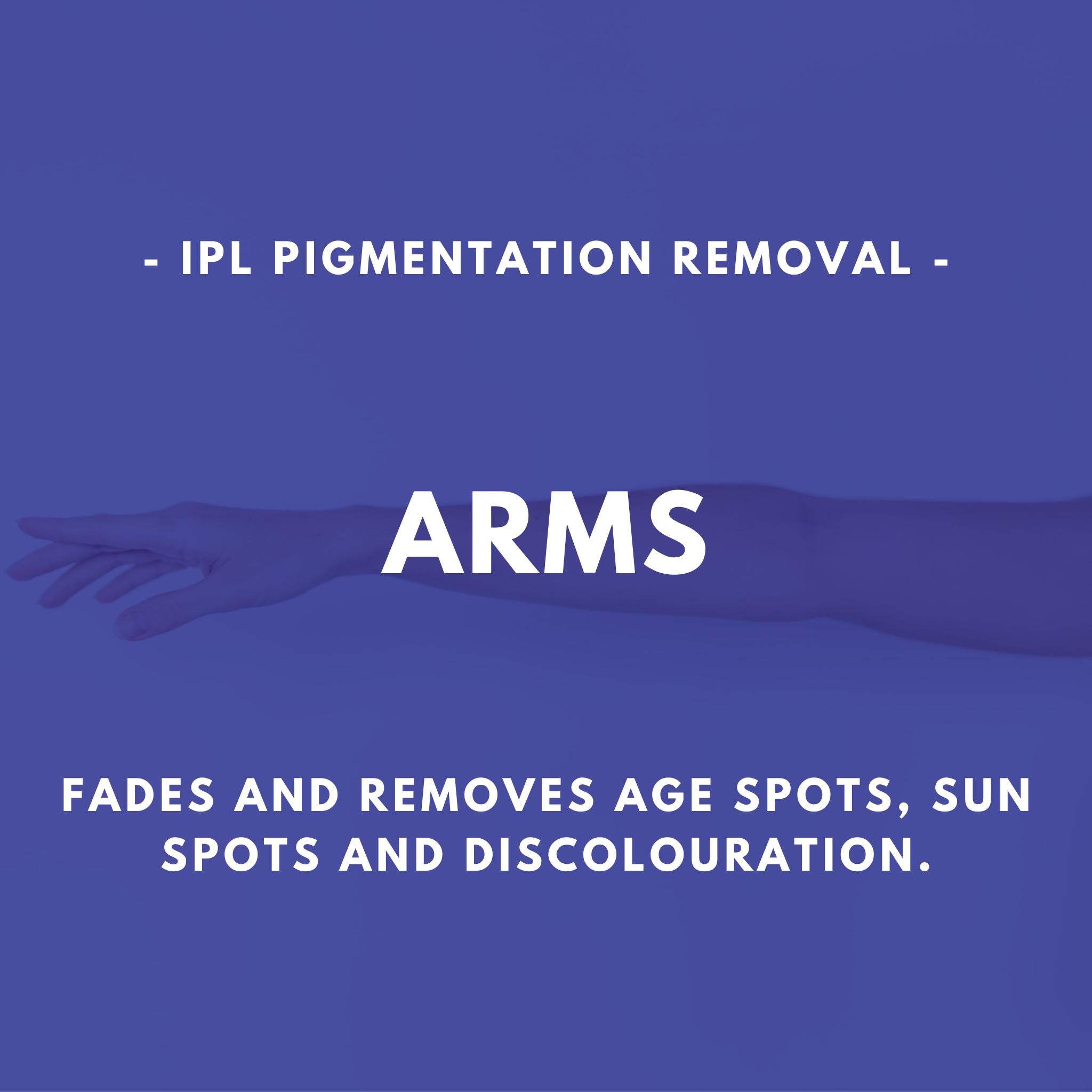 IPL Pigmentation Removal