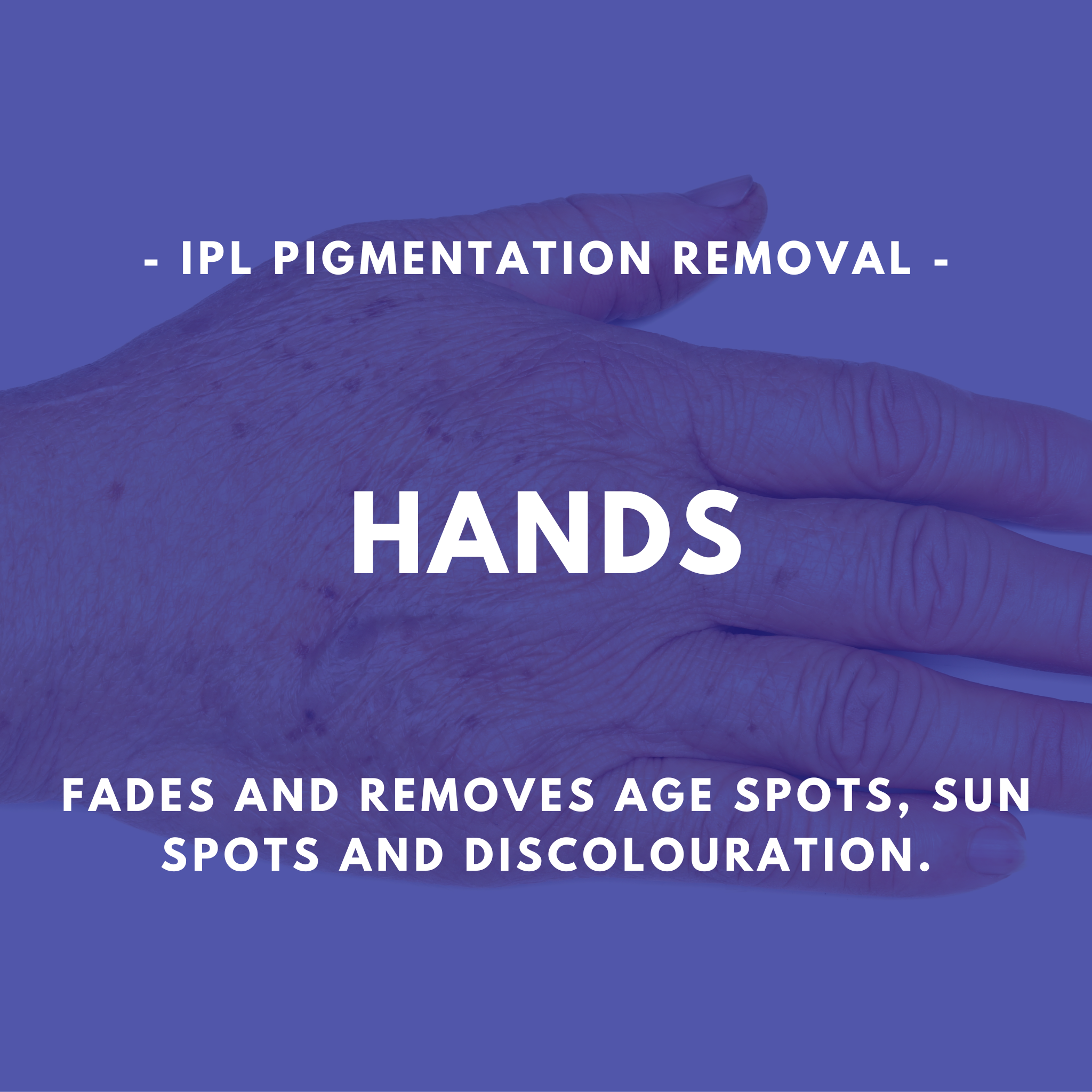 IPL Pigmentation Removal