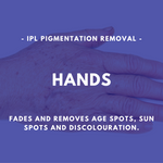 Load image into Gallery viewer, IPL Pigmentation Removal
