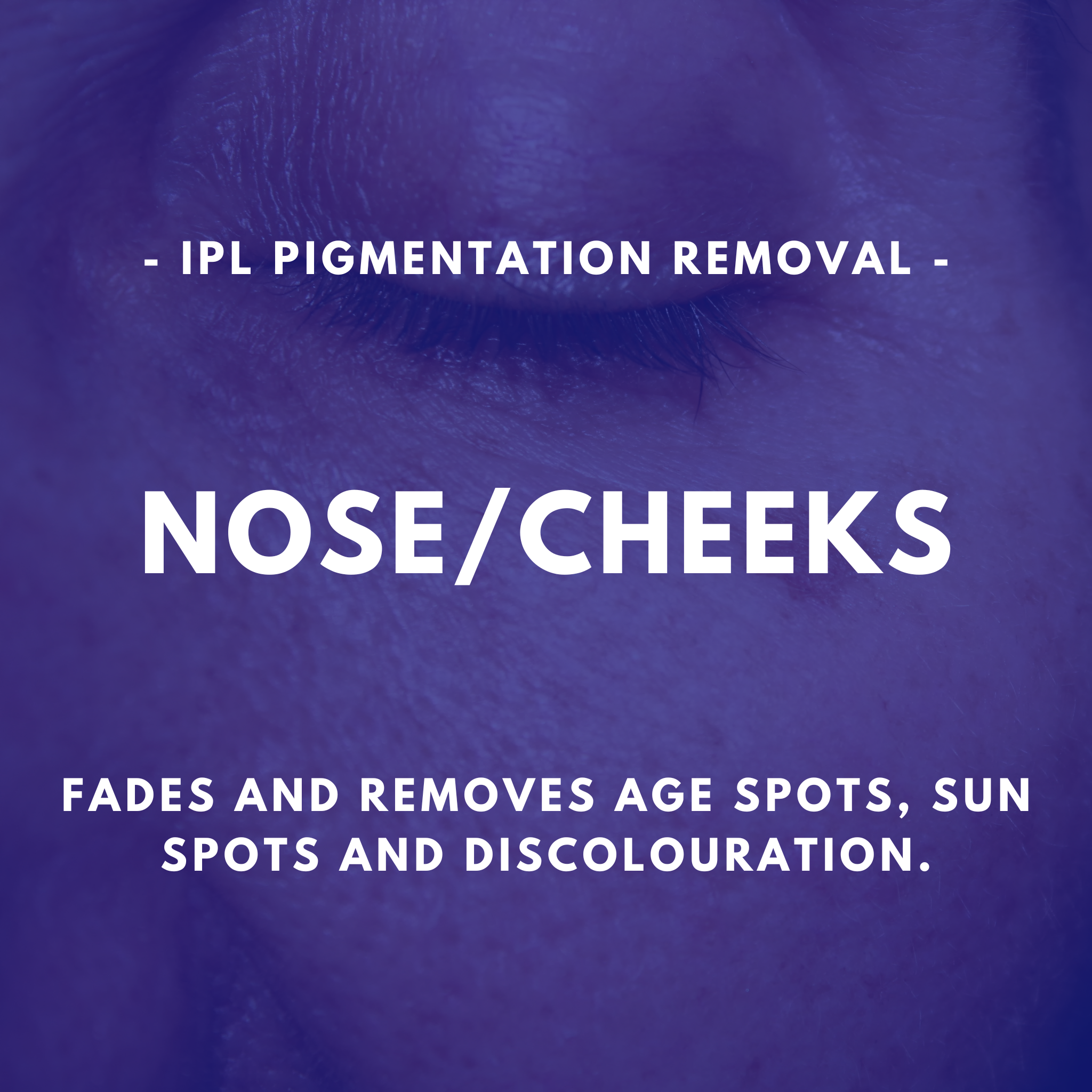 IPL Pigmentation Removal