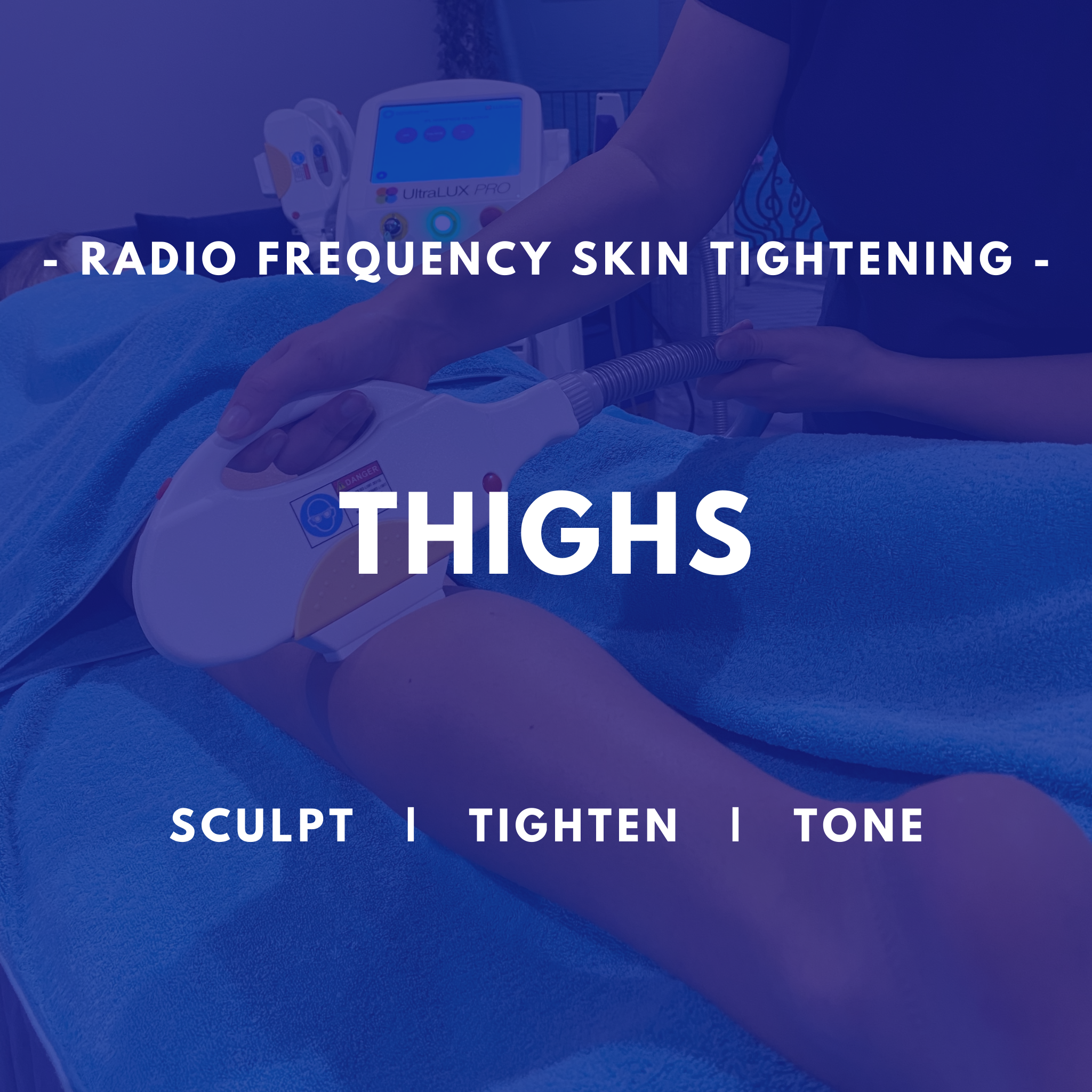 Thighs - RF Skin Tightening