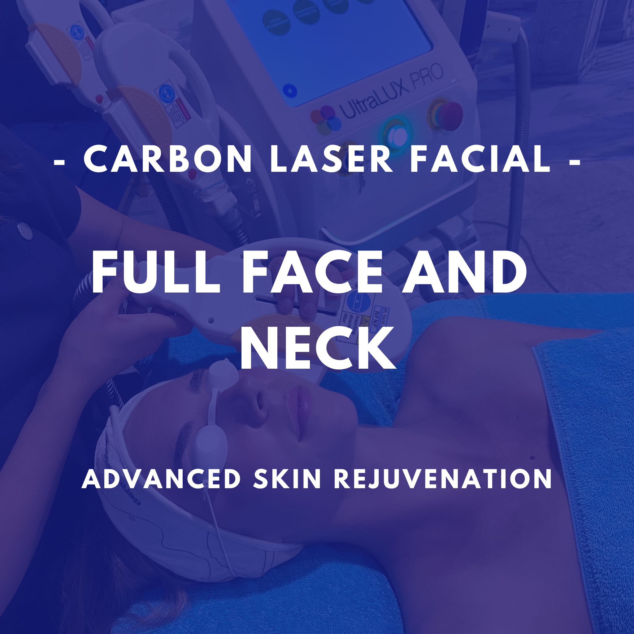 Carbon Laser Facial