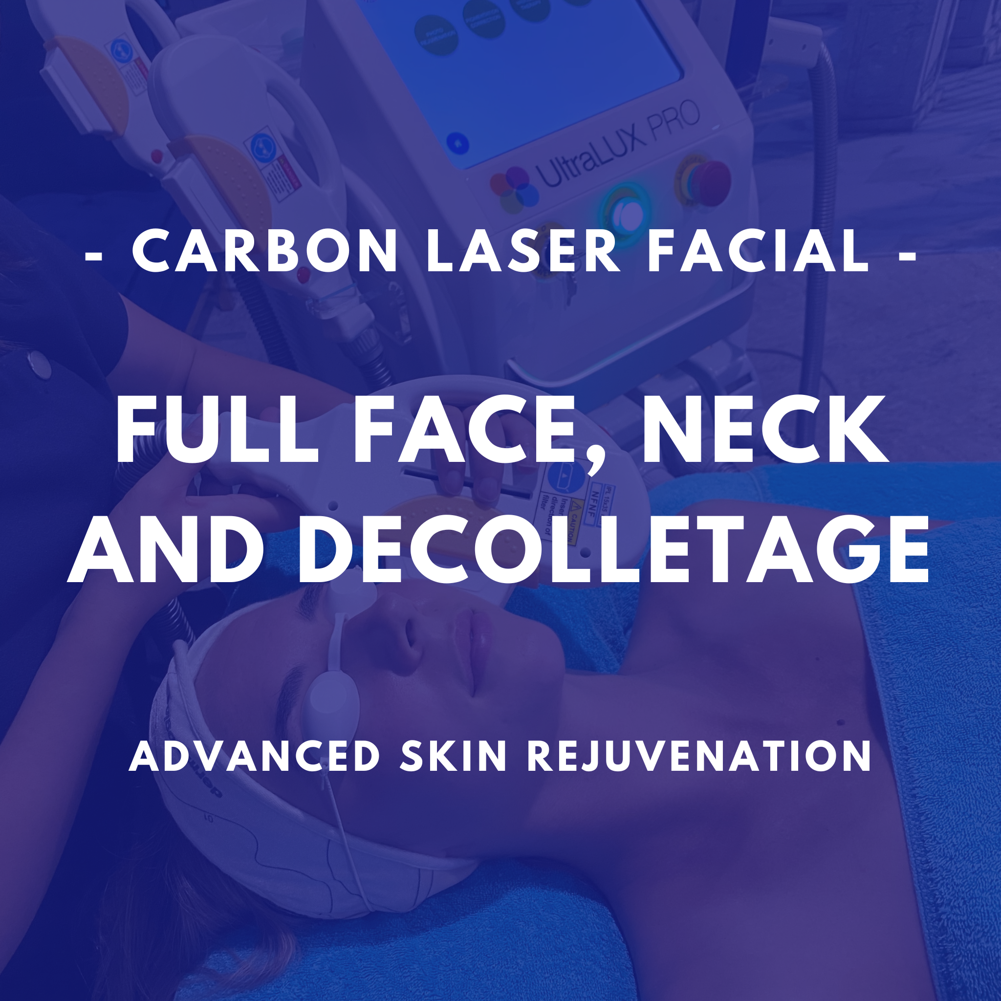 Carbon Laser Facial